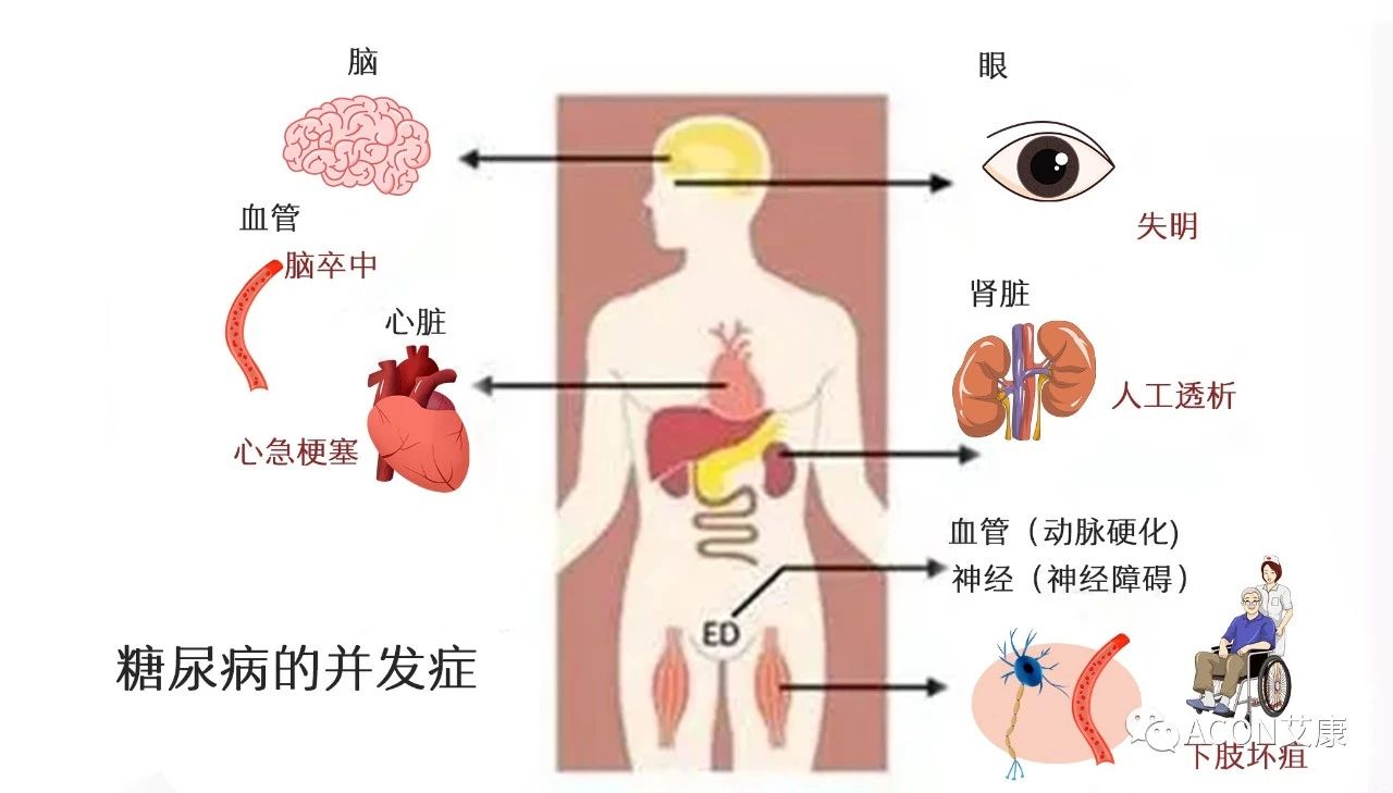 爆上热搜，因爆发型糖尿病进入ICU，有哪些教训值得我们汲取